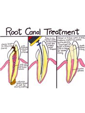 Root canals - LaDenta Dental Clinic Branch of Sei Besitang