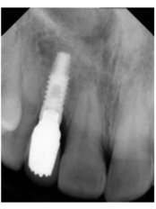 Single Implant - LaDenta Dental Clinic Branch of Sei Besitang