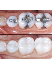 Fillings - LaDenta Dental Clinic Branch of Sei Besitang