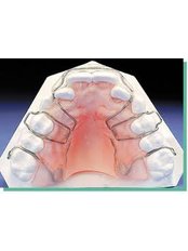 Removable Braces - LaDenta Dental Clinic Branch of Sei Besitang