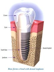 Dental Implants - LaDenta Dental Clinic Branch of Sei Besitang