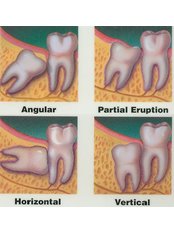 Wisdom Tooth Extraction - LaDenta Dental Clinic Branch of Sei Besitang