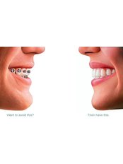 Braces - LaDenta Dental Clinic Branch of Sei Besitang