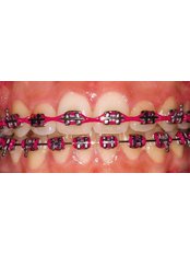 Braces - Dental Care and Spa