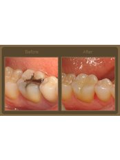 Fillings - Dental Care and Spa