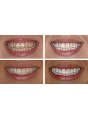 Teeth Whitening - Dental Care and Spa
