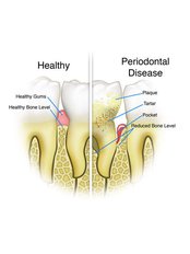 Gingivitis Treatment - Dental Care and Spa