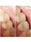 Dra. Margaretha Yessi B. - esthetic composite filling on upper premolar 