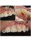 Dra. Margaretha Yessi B. - esthetic composite filling on front tooth 