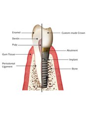 Dental Implants - Jakarta Smile - Family Dental-Citra Garden