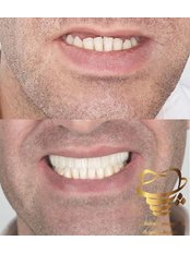 Dental Implants - Dr. Bahman Pouraghdam