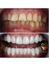 Dental Laminates - Dr. Bahman Pouraghdam