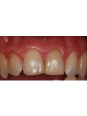 Dental Crowns - Aherne Dental Clinic