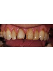Veneers - Aherne Dental Clinic