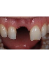 Dental Implants - Aherne Dental Clinic