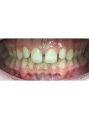 Invisalign™ - River Lee Dental