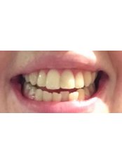Teeth Whitening - River Lee Dental