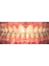 Invisalign™ - River Lee Dental