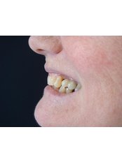 Dental Bonding - The Fresh Breath Clinic- Specialists in Bad Breath Elimination