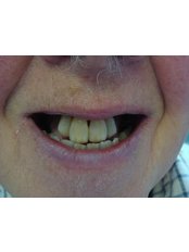 Immediate Dentures - The Fresh Breath Clinic- Specialists in Bad Breath Elimination