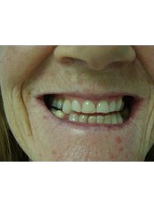 Composite Veneers - The Fresh Breath Clinic- Specialists in Bad Breath Elimination