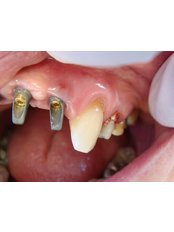 Implant Bridge - The Fresh Breath Clinic- Specialists in Bad Breath Elimination