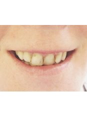 Porcelain Veneers - The Fresh Breath Clinic- Specialists in Bad Breath Elimination