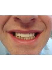 Dental Bridges - The Fresh Breath Clinic- Specialists in Bad Breath Elimination