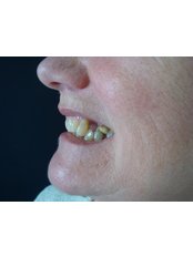 Dental Bonding - The Fresh Breath Clinic- Specialists in Bad Breath Elimination