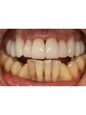 Acrylic Dentures - The Fresh Breath Clinic- Specialists in Bad Breath Elimination