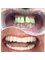 DentiCaredublin - Dental Crown  