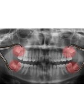 Digital Panoramic Dental X-Ray - DentiCaredublin