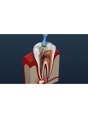 Root Canals - DentiCaredublin