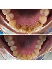 Teeth Cleaning with PRSI Free - DentiCaredublin