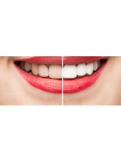Teeth Whitening - DentiCaredublin