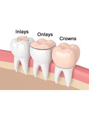 Inlay or Onlay - DentiCaredublin