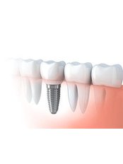 Dental Implants - Dental Artistry