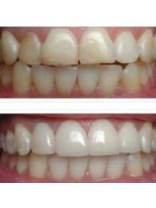 Teeth Whitening - DBdental