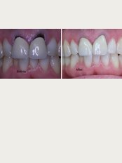 Fairies Cross Dental Clinic - Crowns Before and After
