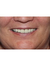 Dental Crowns - Clear Braces/ Dental Options - Clane