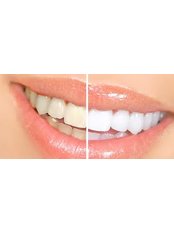 Teeth Whitening - Clear Braces/ Dental Options - Clane