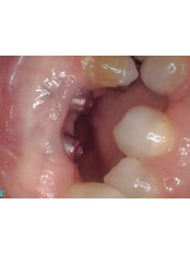 Implant Dentist Consultation - Riverforest Dental Clinic