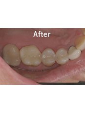 CEREC Dental Restorations - Riverforest Dental Clinic