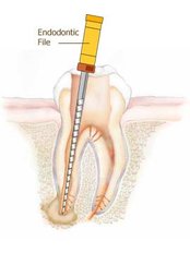 Root canals - Riverforest Dental Clinic