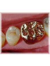Gold Crown - Riverforest Dental Clinic