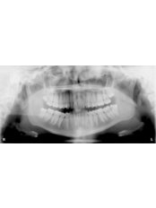 Panoramic Dental X-Ray - Riverforest Dental Clinic