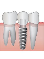 Dental Implants - Riverforest Dental Clinic
