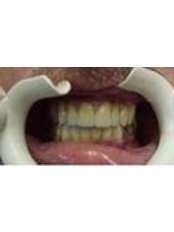 Porcelain Crown - Bio Force Medical & Dental Clinic