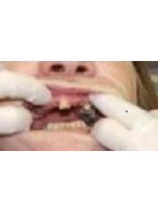 Dental Bridges - Bio Force Medical & Dental Clinic