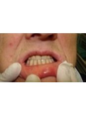 Dental Bridges - Bio Force Medical & Dental Clinic